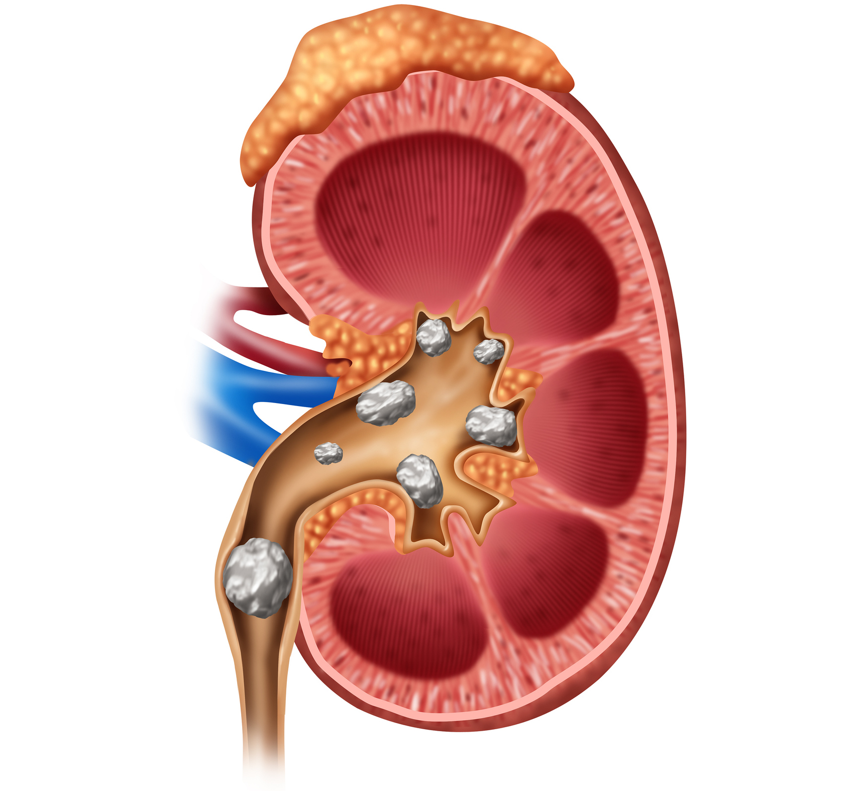 Kidney stone treatment in Kanpur