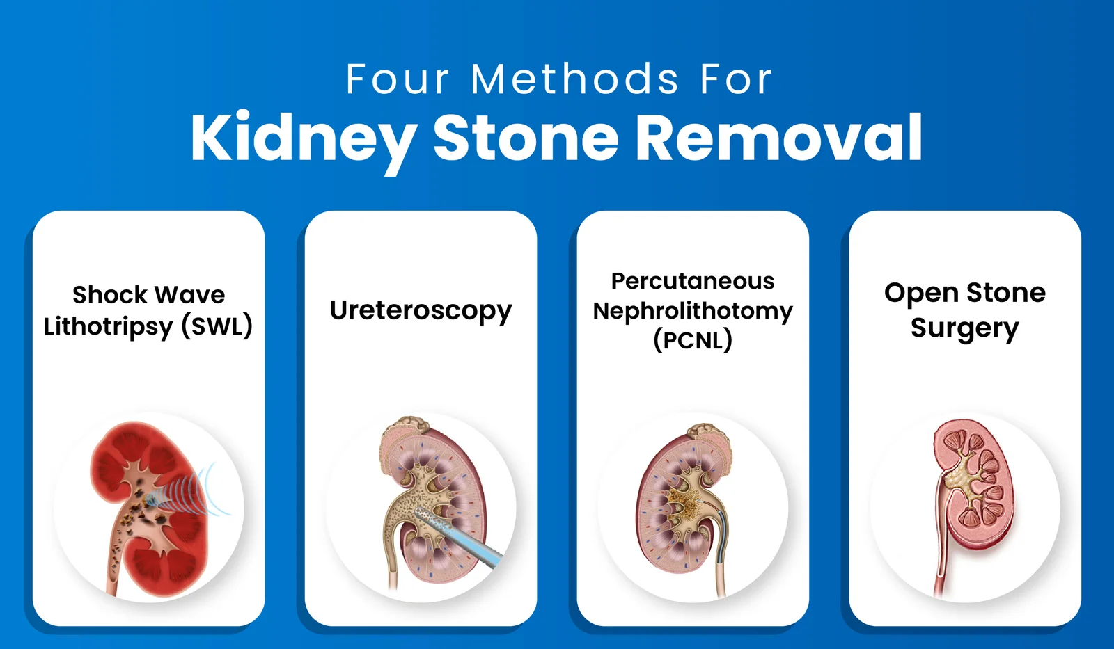 Four methods for kidney stone removal